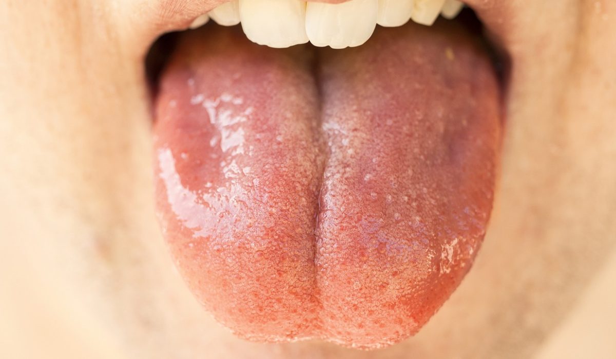 mucositis, stan zapalny jamy ustnej